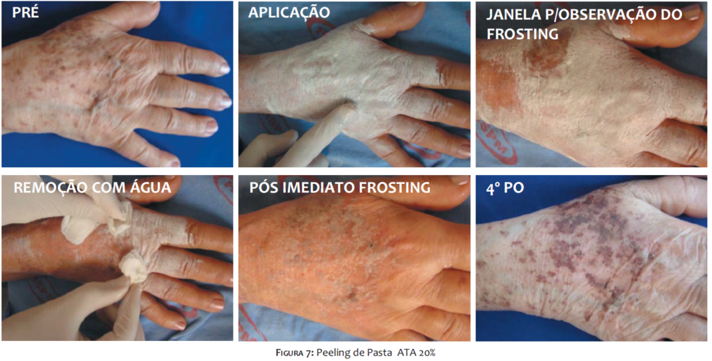 Peeling De Ata Cido Tricloroac Tico Marcio Guidoni