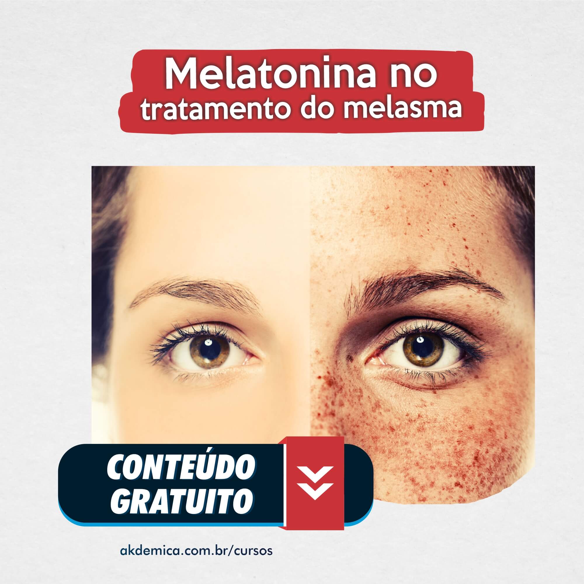 Leia mais sobre o artigo Melatonina tópica e oral no tratamento do melasma